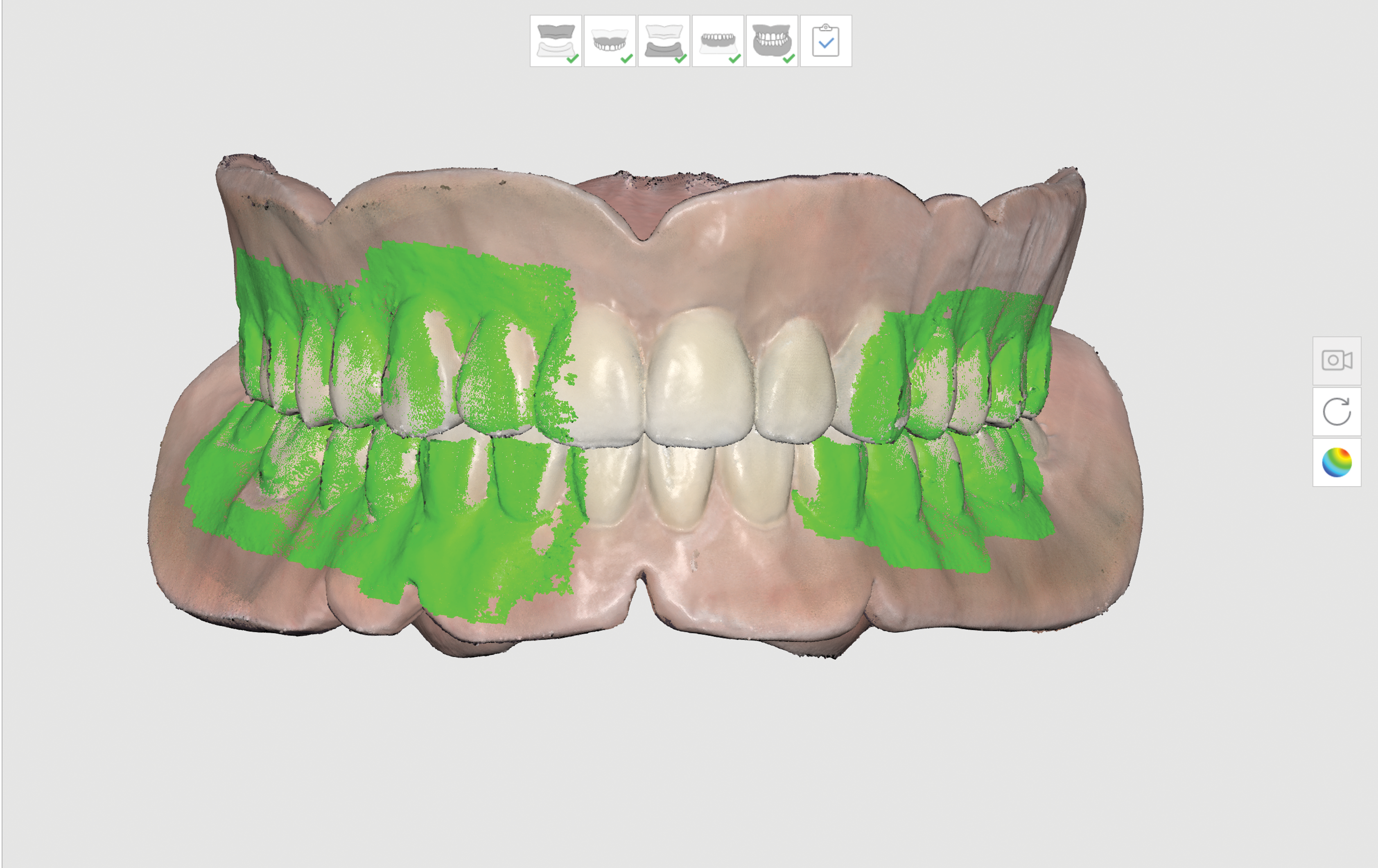Denture Scanning